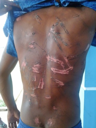 Blasius Sumaghai's injuries following his beating by Indonesain Navy Officers